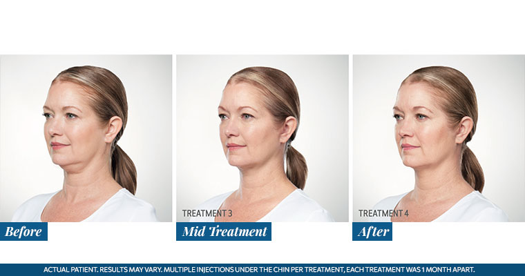 /images/results/img-procedure-results-botox-dysport-06.jpg